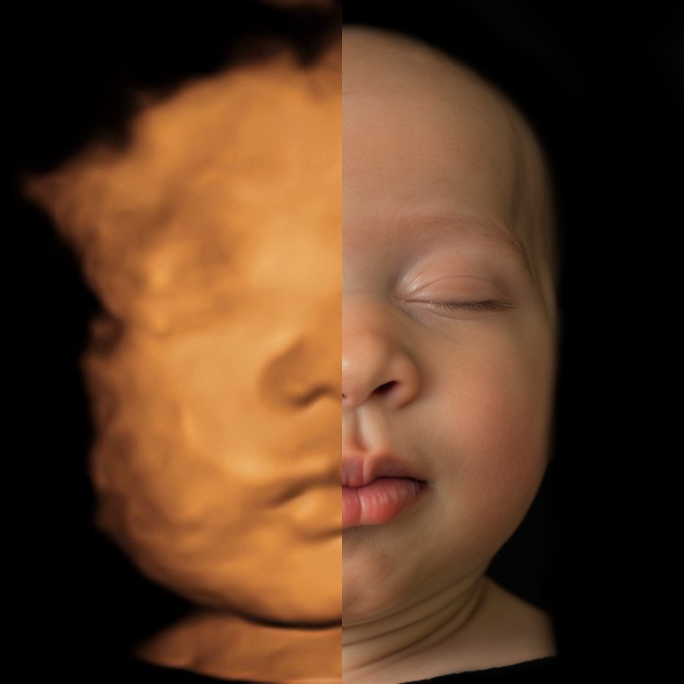 Real View Ultrasound Photo